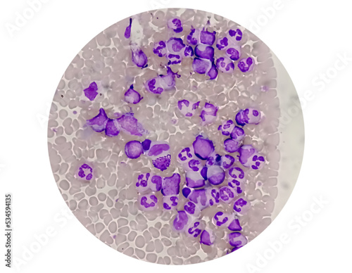 Chronic myelogenous leukemia (CML), also known as chronic myeloid leukemia, is a cancer of the white blood cells. chronic granulocytic leukemia  photo