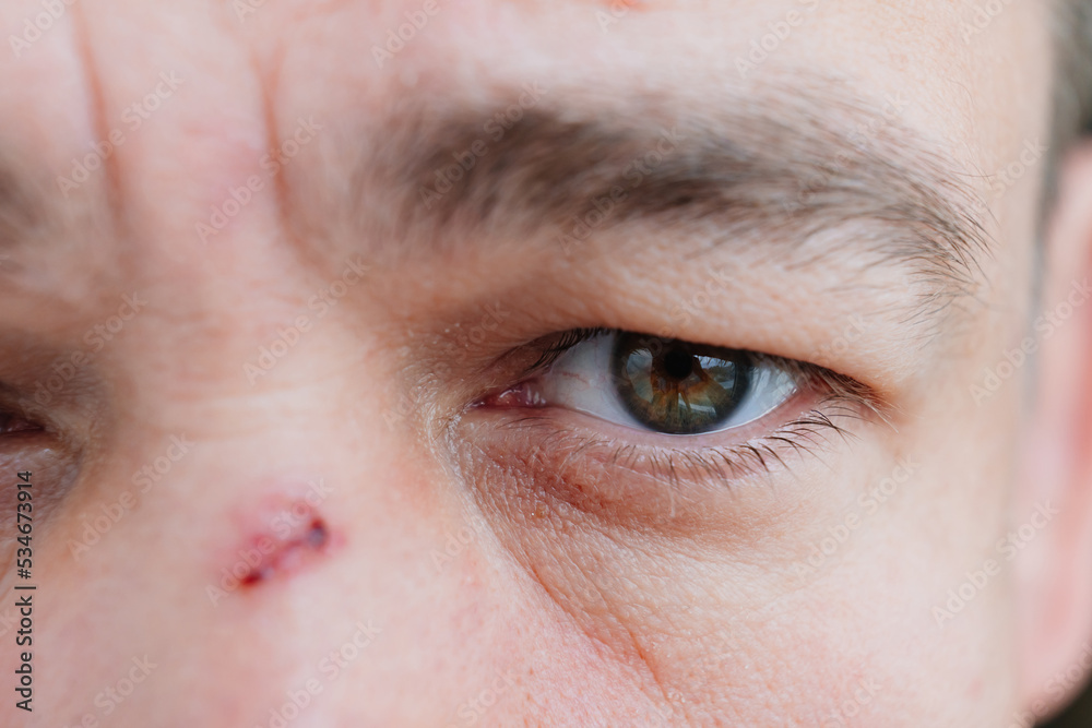 Obraz premium close-up. bloody abrasion on the bridge of the nose of a man after a blow. 