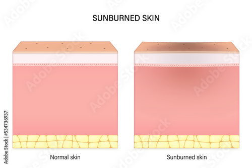 Sunburned skin. Comparison of normal skin and sunburn. Facial skin problems. Vector for advertising about beauty and medical treatment.