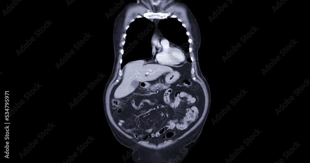 CT SCAN of Chest and Abdomen with injection contrast media for ...
