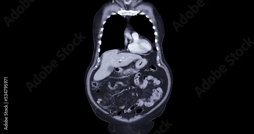 CT SCAN of Chest and Abdomen with injection contrast media for diagnonsis chest and abdomen disease. photo