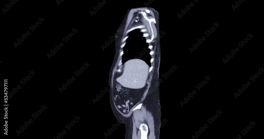 CT SCAN of Chest and Abdomen with injection contrast media for diagnonsis chest and abdomen disease. CT SCAN of Chest and Abdomen with injection contrast media for diagnonsis chest and abdomen disease.