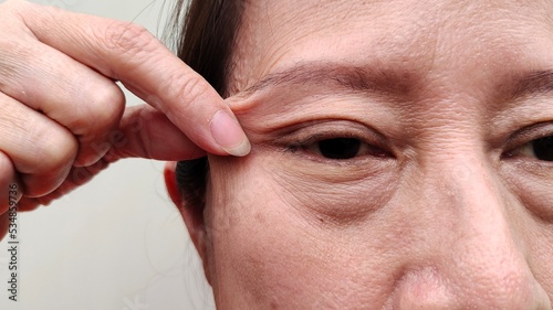 Portrait the fingers squeezing the flabbiness adipose sagging skin beside the eyelid, ptosis and flabby skin on the eyes, blemish and freckles on the face, wrinkles and dark spots of the woman. photo