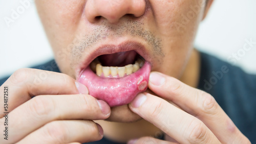 Painful aphtha ulcer man's mouth from accident or not enough sleep photo
