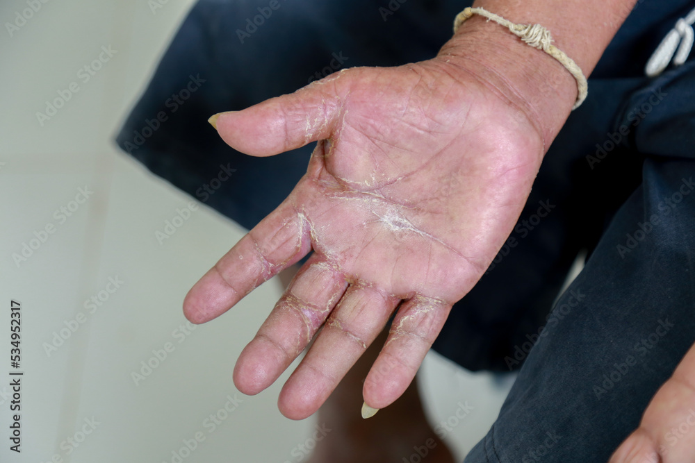 Skin disorder, pepper appearance from scleroderma, autoimmune disease