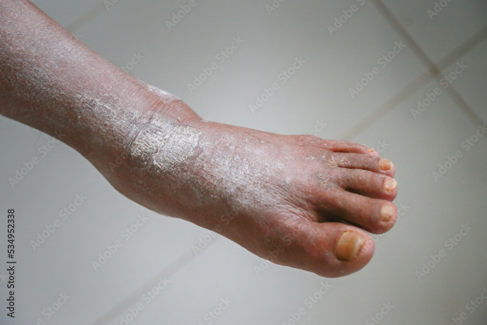 Skin disorder, pepper appearance from scleroderma, autoimmune disease