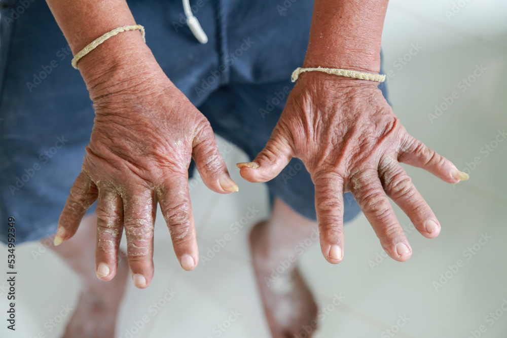 Skin disorder, pepper appearance from scleroderma, autoimmune disease