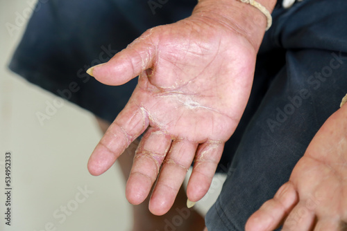 Skin disorder, pepper appearance from scleroderma, autoimmune disease male hand Skin disorder pepper appearance from vitiligo,scleroderma raynaud, medical concept autoimmune disease. Skin disorder,