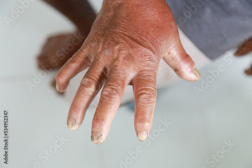 Skin disorder, pepper appearance from scleroderma, autoimmune disease male hand Skin disorder pepper appearance from vitiligo,scleroderma raynaud, medical concept autoimmune disease. Skin disorder,