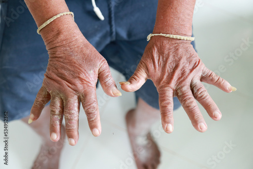 Skin disorder, pepper appearance from scleroderma, autoimmune disease male hand Skin disorder pepper appearance from vitiligo,scleroderma raynaud, medical concept autoimmune disease. Skin disorder,