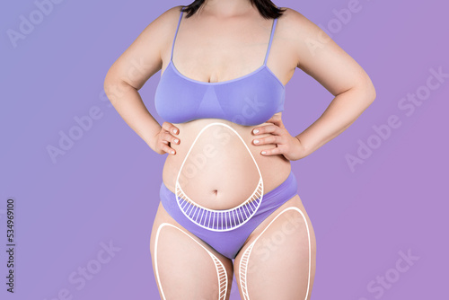 Abdomen and hips liposuction, fat and cellulite removal concept, overweight female body with painted surgical lines and arrows photo