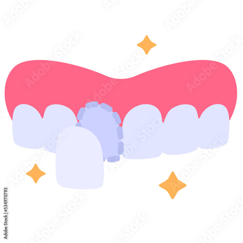 Veneers