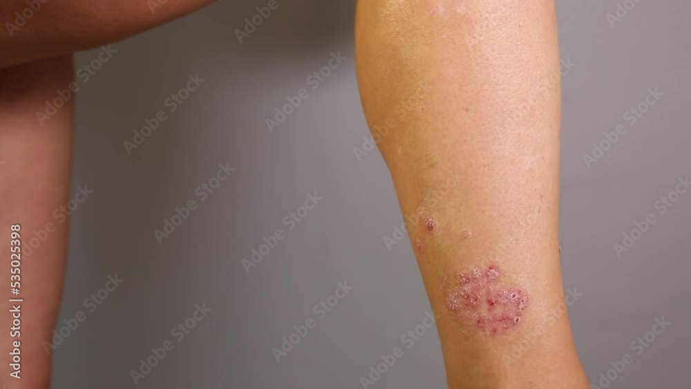 Close-up of an unrecognizable woman, acute psoriasis on her leg, which ...