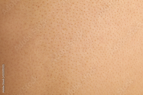 Texture of human skin with birthmarks, closeup view
