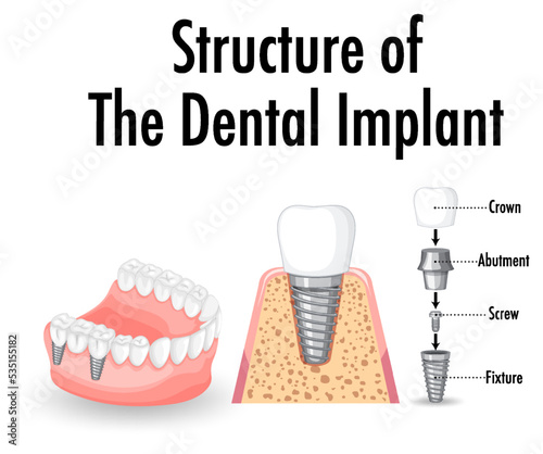Infographic of human in structure of the dental implant