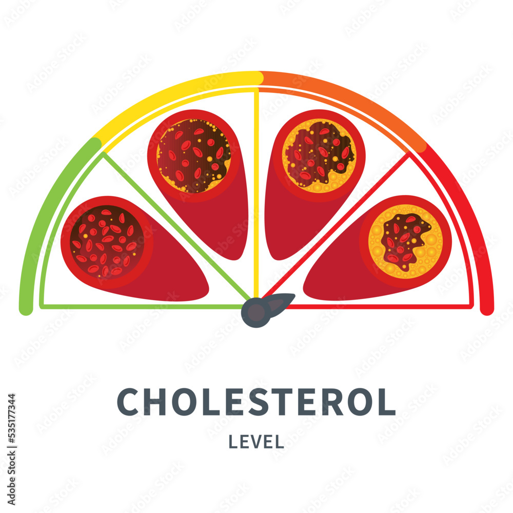 Cholesterol level on blocked blood vessel medical diagram