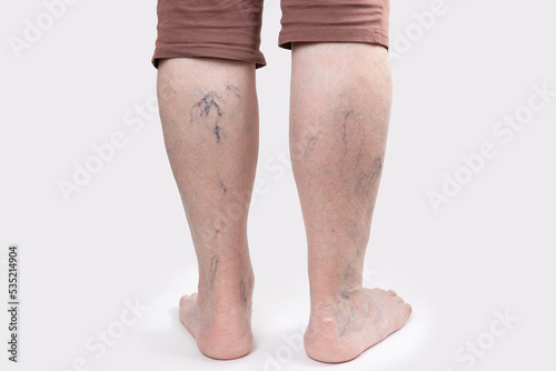 Varicosity. Close up view of old legs of woman with vascular asterisks. Back view. White background. The concept of varicose veins photo
