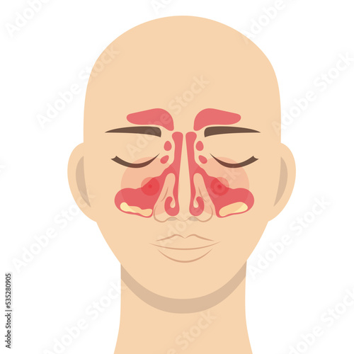 A human head with a schematic image of the maxillary sinuses, inflammation and accumulation of pus in the maxillary sinuses with sinusitis photo