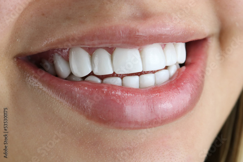 white perfect teeth woman perfect smile