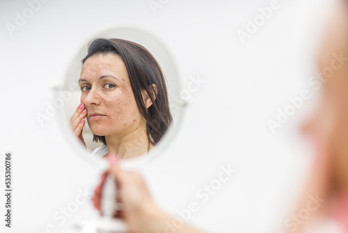 Photo of woman having skin problems looking in the mirror. photo