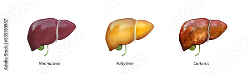 Normal liver versus liver with Cirrhosis, damaged liver, excessive drinking of alcohol, treatment, photo