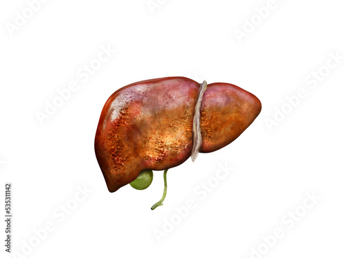 Realistic illustration sick cirrhosis human livers, damaged liver, excessive drinking of alcohol, treatment