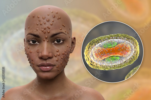 Patient with monkeypox and close-up view of monkeypox virus, 3D illustration photo