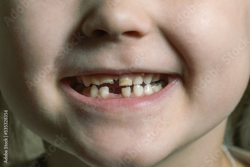 Children's mouth with fallen and broken milk teeth photo