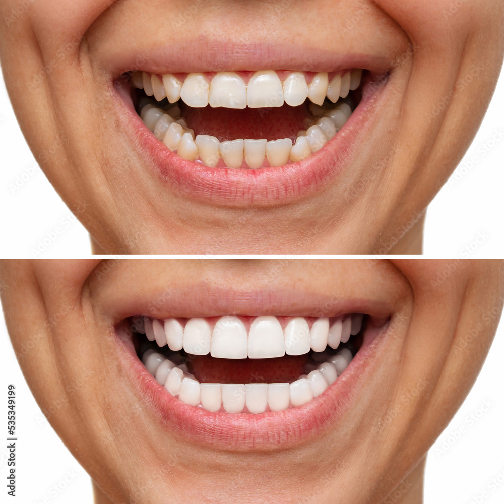 Cropped shot of a young caucasian smiling woman before and after veneers installation. Teeth whitening. Dentistry, dental treatment Cropped shot of a young caucasian smiling woman before and after veneers installation. Teeth whitening. Dentistry, dental treatment