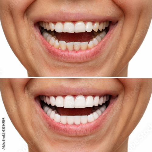 Cropped shot of a young caucasian smiling woman before and after veneers installation. Teeth whitening. Dentistry, dental treatment