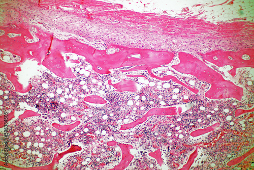 Microscope of Adenoid cystic carcinoma, rare type of cancer exist in many different body sites. This tumor occurs in the salivary glands, with close up macro 40x lens, microbiology laboratory concept.