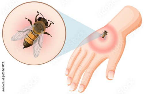 Bee bites sting on skin