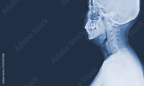X-ray C-spine Moderate spinal cord compression at C5-6, Medical image concept, and copy space.