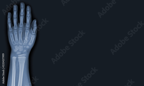 x-ray images of the hand and wrist joint to see injuries tendons and radius bone fracture for a medical diagnosis.Medical image concept and copy space.