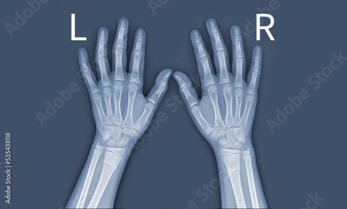 x-ray images of the both hand and wrist joint ap views to see injuries tendons and radius bond fracture for a medical diagnosis.Medical image concept and copy space.