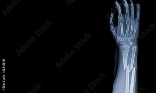 Fotografie x-ray images of the both hand and wrist joint ap views to see injuries radius and ulna bond fracture for a medical diagnosis