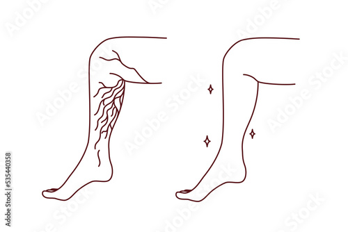 Close-up of unhealthy and healthy leg with varicose veins. Patient suffer from varicoses. Healthcare and medicine. Vector illustration. 