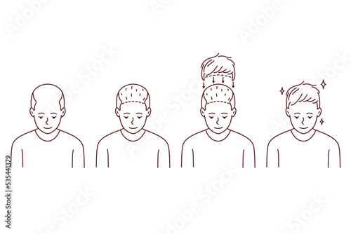 Stages on man hair transplant. Treatment of baldness and alopecia. Set of male patient follicular unit extraction. Vector illustration. 
