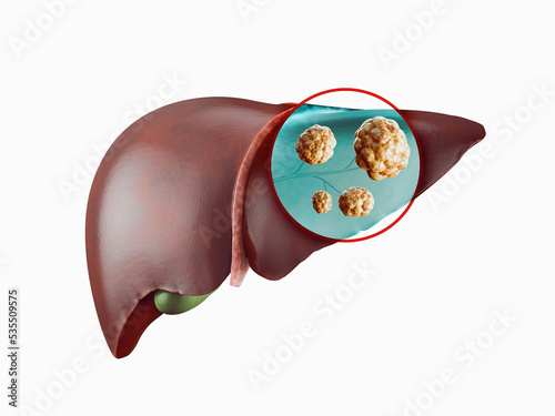 Realistic 3d illustration of cancer of human liver isolated on white photo