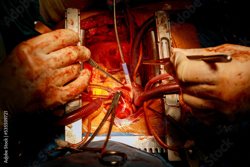 CABG is a type of bypass surgery used for heart operations caused by coronary heart disease in a hospital operating room