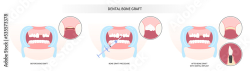 surgery of oral teeth bone graft procedure
