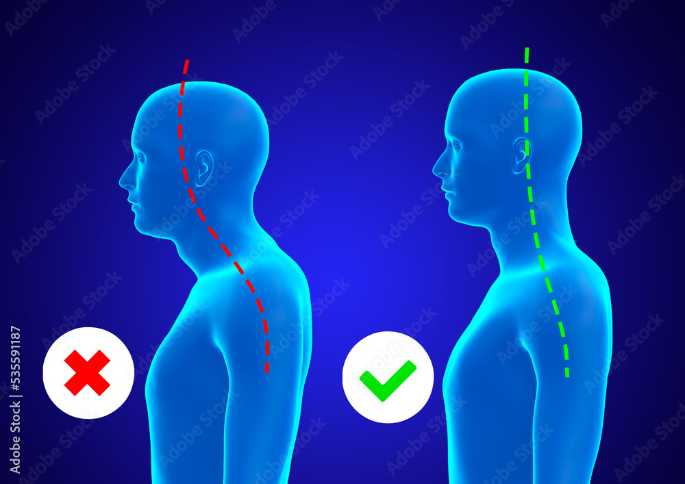 Incorrect and correct posture of the cervical spine of a blue hologram of a man - obrazy, fototapety, plakaty 