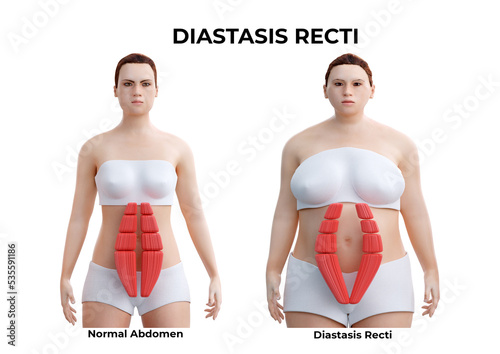 Abdominal diastasis is the partial or complete separation of the rectus abdominis muscles, common during and after pregnancy photo