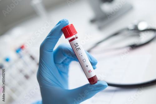 Laboratory: Blood sample positive with systemic lupus erythematosus SLE photo