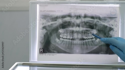 Close up dentist showing to patient teeth x-ray in dental clinic. Dental Xray of jaw with teeth photo