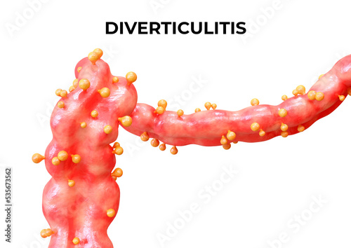 Diverticulitis is a disease that occurs when the diverticula of the large intestine become inflamed or infected, and may present an abscess or perforation photo