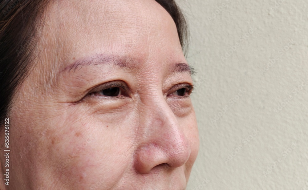 portrait the flabbiness adipose sagging skin and ptosis beside the eyelid, freckles and blemish on the face, dark spots and rough skin under the eyes of the woman, concept health care.