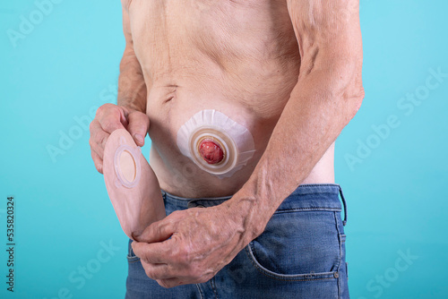 stoma care photo