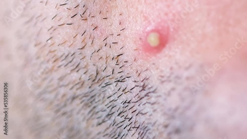 Macro video, squeezing a white pimple from the face. 
