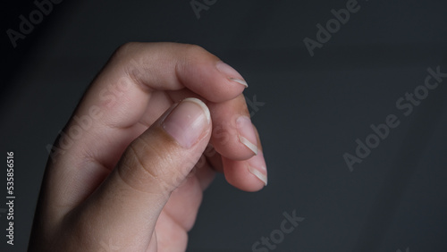 White Spots on Children's Nails, Due to Calcium Deficiency. This disease is called leukonychia.